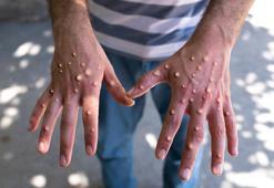 Gana'da 34 M-çiçeği vakası tespit edildi