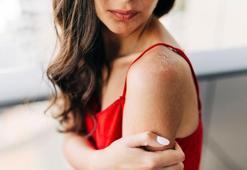 Düzenli tüketince cildi yatıştırıyor! Güneş alerjisine karşı etkili çözüm