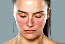 Yüzünüzdeki lekeler lupus belirtisi olabilir! Pek çok organı etkileyebiliyor