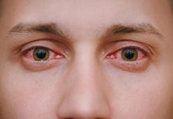 Yaz aylarındaki riskleri göz ardı etmeyin! Kalıcı görme kaybına neden olabilir