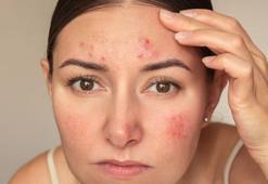 Bebeksi bir cilt bu ipuçlarıyla mümkün! Yaz aknelerini önleyen rutin