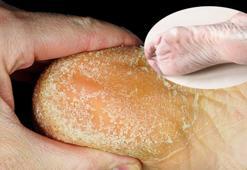 Güzellik uğruna yara eden var! Çatlayan topuk böyle iyileşiyor, ovalamaya hayır