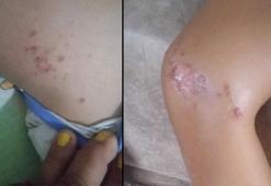 9 yaşındaki çocuk denizden çıktıktan sonra fenalaştı! Vücudunda çıkan lekelerle ilgili korkunç şüphe