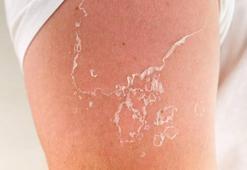 Güneş yanığı sonrası cilt soyulmasına ne iyi gelir? İşte cilt soyulmasına iyi gelen yöntemler