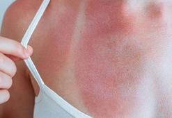 Güneşin sessiz tehdidi: Yanıklar! Kimler daha fazla risk altında?