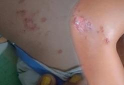 Serinlemek için girdi, yanıkla çıktı! Denizde enfeksiyon paniği: 'Buradan vücuda giriyor'