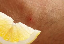 Sinek ısırığına çare limon suyu! Kaşıntıyı anında alıyor, böyle uygulayın