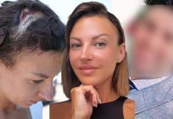 Uzaklaştırma kararı sonrası vahşet! Kafatasına zımba atıldı, elleri kırıldı: Plan yapıp beni öldürmeye geldi