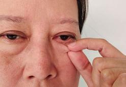 Gözde kızarıklık ve yanmaya neden oluyor! Görme kayıpları yaşanabiliyor