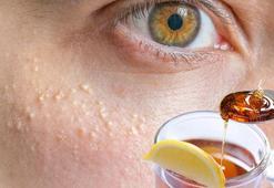 Yüzdeki yağ bezelerine bal-limon darbesi! Operasyona gerek yok, 2 kez süren yaşadı