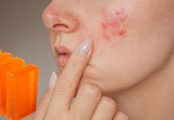 'Sivilcem geçti ama iz kaldı' diyenlere müjde! Kojik sabunu lekeleri silip süpürüyor