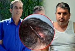 Miras yüzünden yeğenini beyzbol sopasıyla darbeden dayıdan şok sözler: Beni tahrik etti, dayanamadım