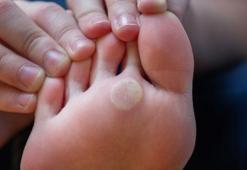 Nasır deyip geçmeyin, ciddiye alın! Ayak sağlığını tehdit ediyor