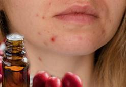 Yara izlerini bile kapatan ev yapımı serum! Cildi anında onarıyor, ne akne kalacak ne sivilce