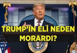 TRUMP'IN ELİ NEDEN MORARDI? Kronik Venöz yetmezlik nedir? Venöz yetmezlik belirtiler, nedenleri ve tedavisi nedir?