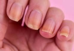 Tırnak sararmalarına birebir! Hem güçlendiriyor hem de sağlıklı uzatıyor