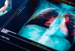 Sessiz ilerliyor, nefesinizi kesiyor: Akciğerde sıvı birikmesi nedir?