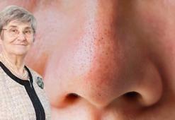 Canan Karatay önerdi, gözenekleri sıkıştıran mucize besinmiş! İçeriden kapatıyor