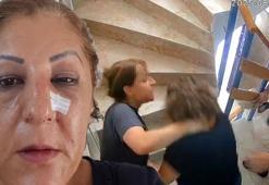 Ankara’da komşu kabusu! Kedileri beslediği için burnunu kırdılar: 'Bugün seni öldüreceğiz’