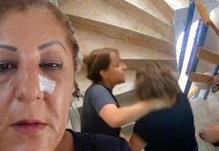 Ankara’da komşu kabusu! Kedileri beslediği için burnunu kırdılar: 'Bugün seni öldüreceğiz’