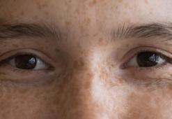 Cilt lekelerini uçuran limon kürü! 20 dakika uygulayan farkı görüyor, herkeste var