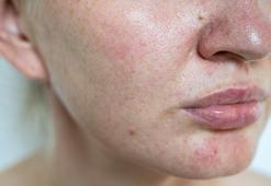 Yazdan kalan cilt lekelerine son! Evde uygulayabileceğiniz en basit yöntem