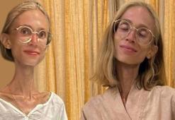 22 kiloya kadar düştü! Sosyal medya fenomeni hayatını kaybetti