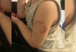 Edirne'de akılalmaz olay! Öğretmen, 3 yaşındaki çocuğu ısırdı: Öperken oldu