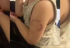 Edirne'de akılalmaz olay! Öğretmen, 3 yaşındaki çocuğu ısırdı: Öperken oldu