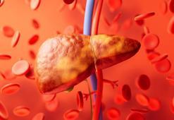 Karaciğer nakillerini artıran sinsi tehlike: Fruktozlu gıdalar!