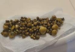 77 yaşındaki kadının safra kesesinden 213 adet taş çıktı