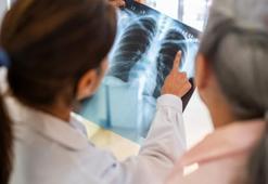 5 dakikalık kontrol hayatınızı değiştirebilir! Geçmeyen öksürük ilk belirtisiymiş