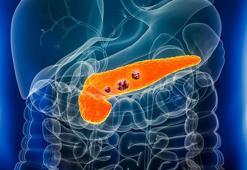Pankreas kanserinde umutları artıran gelişmeler: 'Sağ kalım oranı yüzde 54'e yükseldi'