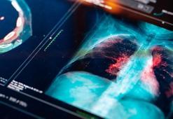 Akciğer kanseri neden sigara içmeyenlerde görülüyor?