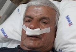 Meslekten dolayı oluşmuş! 65 yaşındaki adamın burnundan taş çıkarıldı