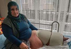 19 yaşında yakalandığı fil hastalığı nedeniyle 205 kiloya çıktı! 35 yıldır mücadele ediyor