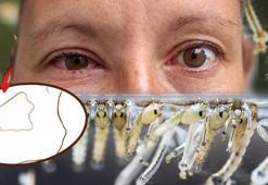 Gözüne inen solucanla aylarca yaşadı: 'Çok nadir ama Türkiye de risk kuşağında'