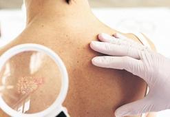 ‘Sedef’ zengin hastalığı mı?