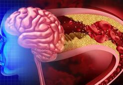 İnme sonrası hayata yeniden başlayanlar anlattı! 'Milattan önce ve sonrası gibi'