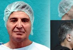 Devlet hastanesinde bir ilk! Yüz germe operasyonuna girdi, 15 yıl gençleşerek çıktı