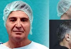 Devlet hastanesinde bir ilk! Yüz germe operasyonuna girdi, 15 yıl gençleşerek çıktı