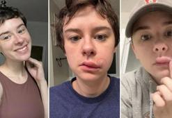 Sıradan bir sivilce sandı, yüz felciyle hastaneye kaldırıldı! Ölüm üçgeni gerçeği