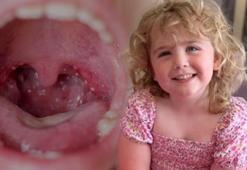 Bademcik ameliyatı 5 yaşındaki kızı hayattan kopardı! Ölümün ardındaki 'tek gece' detayı