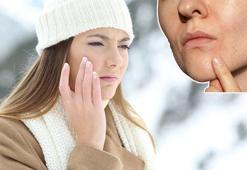 Soğuk hava cildi kurutup, sorunlara yol açıyor! 10 adımda önlemek mümkün