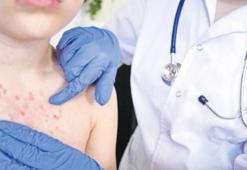 Geri mi dönüyor? Su çiçeği vakalarında artış