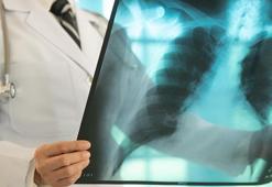 Bu tedavi beklenmeyen riski artırıyor: Tüberküloz yeniden yükselişte