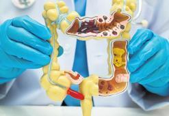 Kolon kanserinde kritik 50 YAŞ eşiği