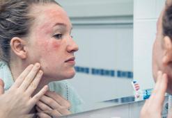 Soğuk hava en çok yüz, el ve dudağı kurutuyor! Kışın pamuk gibi bir cilt mümkün