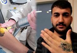 Dövme sildirecekti kabusu oldu: Deri ve doku nakli yapılacak! 'Herkes ve her dövme uygun değil'