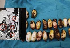 44 kapsül bonzaiyi midesinde saklamış! Cerrahi müdahale ile çıkarıldı